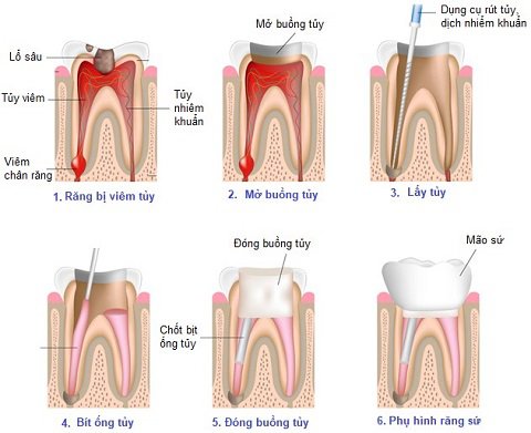 Description: Các bước hàn ống tủy điều trị viêm tủy răng | Vinmec